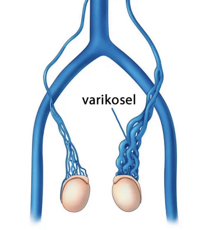 Testis çevresindeki ince, normal damarlar ile genişlemiş ve kıvrımlı varikosel damarlarının karşılaştırması